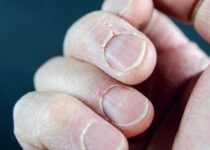 Трещины на руках и пальцах: причина и лечение. Сухая кожа и очень сухие руки. Почему трещины не заживают? Причины. Лечение. Что делать?