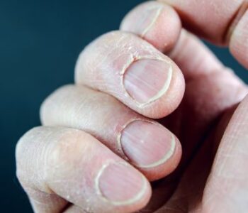 Трещины на руках и пальцах: причина и лечение. Сухая кожа и очень сухие руки. Почему трещины не заживают? Причины. Лечение. Что делать?