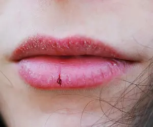 Обветренные губы. Что делать и чем лечить
